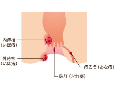 痔との関連