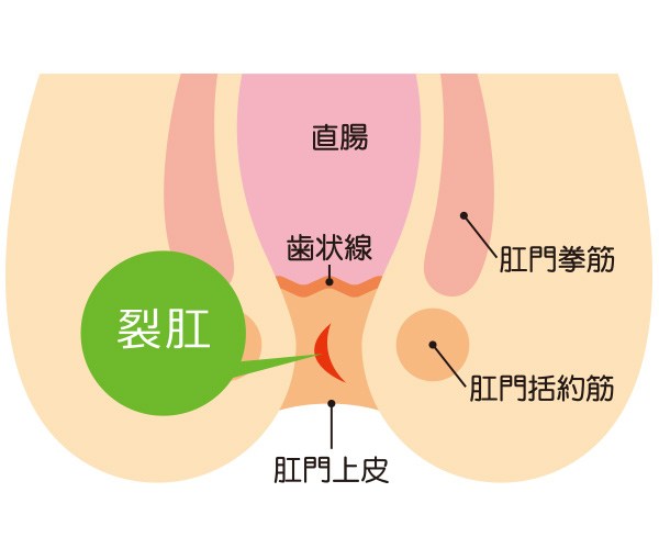 切れ痔（裂肛）とは？