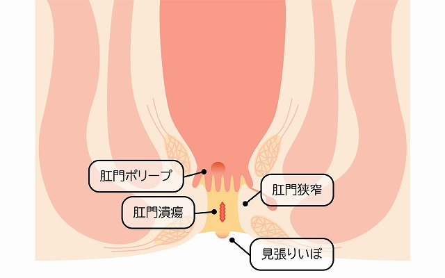 肛門ポリープとは？